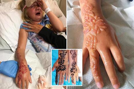 Burn from black henna or unsafe henna tattoo